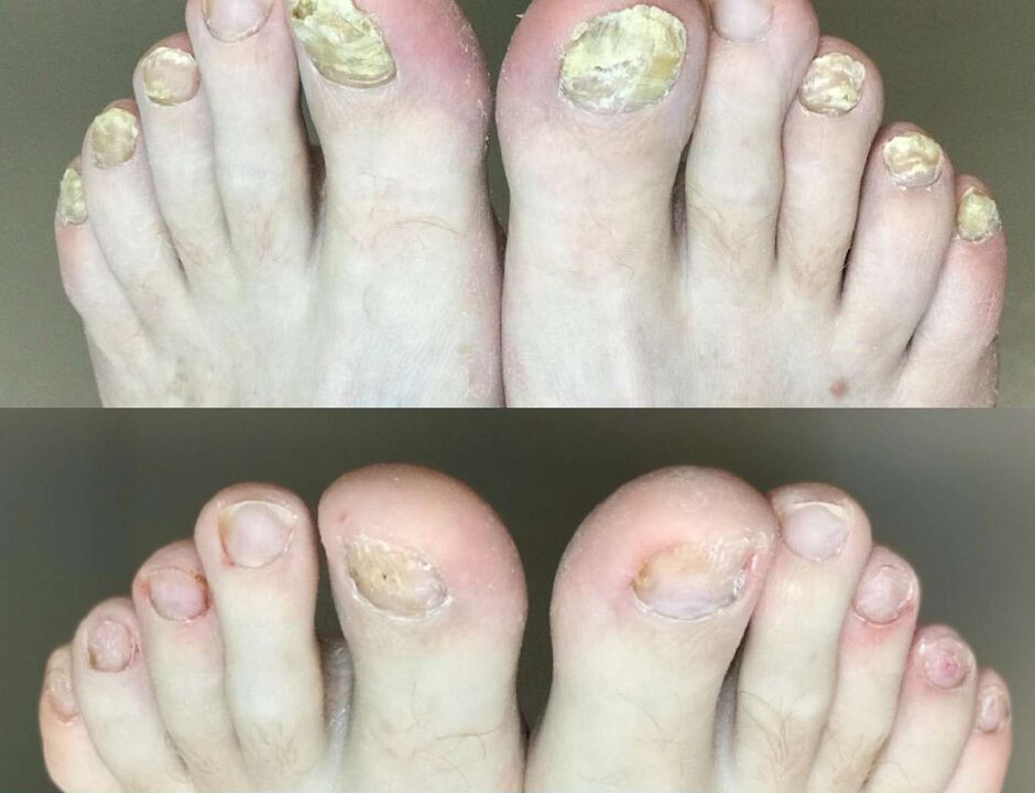 Avant et après le traitement, la crème promisil aux champignons