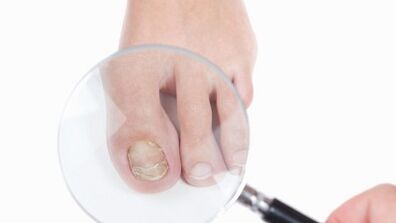 Comment traiter un champignon au pouce de la jambe