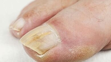 Les raisons de l'apparence du champignon sur le pouce de la jambe