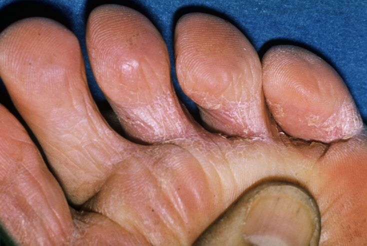 Champignon sur les orteils