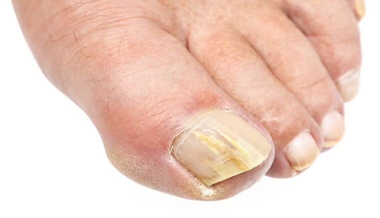 Les changements externes sur l'ongle sont le signe d'une infection fongique