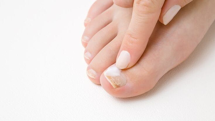 Type de champignon des ongles