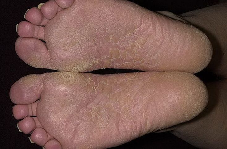 La peau sèche et squameuse des pieds est un signe de pellicules