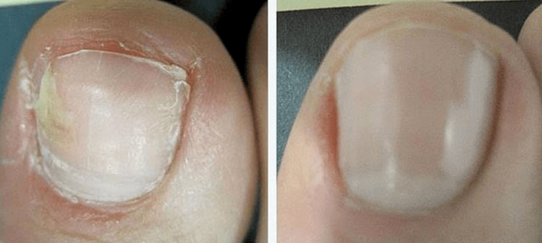 Ongles avant et après traitement fongique