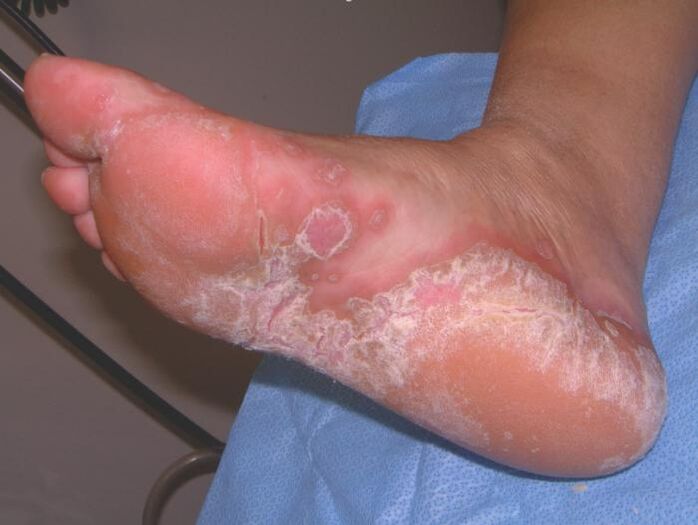 Pied touché par une infection fongique